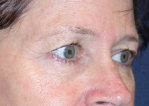 Blepharoplasty (Eyelid Lift) Before and After Pictures