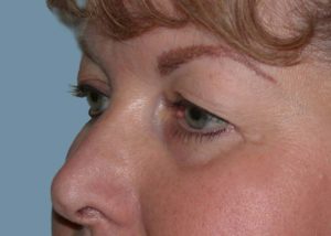 Blepharoplasty (Eyelid Lift) Before and After Pictures