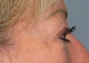 Blepharoplasty (Eyelid Lift) Before and After Pictures