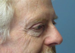 Blepharoplasty (Eyelid Lift) Before and After Pictures