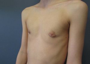 Transgender Top Surgery Before and After Pictures