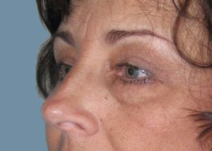 Blepharoplasty (Eyelid Lift) Before and After Pictures