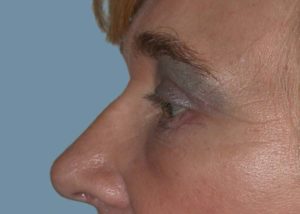 Blepharoplasty (Eyelid Lift) Before and After Pictures