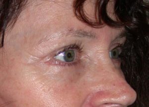 Blepharoplasty (Eyelid Lift) Before and After Pictures