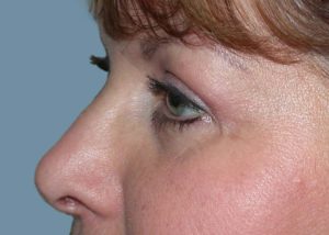 Blepharoplasty (Eyelid Lift) Before and After Pictures