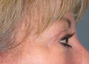 Blepharoplasty (Eyelid Lift) Before and After Pictures