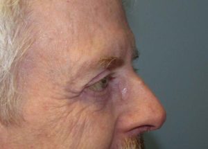 Blepharoplasty (Eyelid Lift) Before and After Pictures