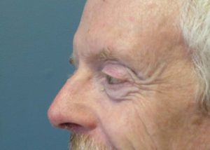 Blepharoplasty (Eyelid Lift) Before and After Pictures