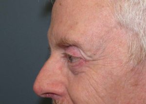 Blepharoplasty (Eyelid Lift) Before and After Pictures