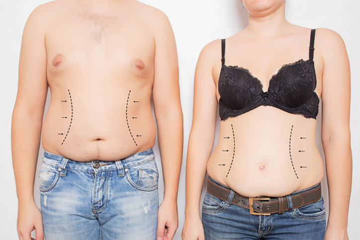 Tummy Tuck Myth vs. Fact