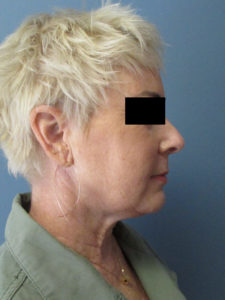 Neck Lift in San Diego, CA