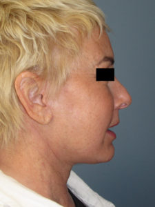 Neck Lift in San Diego, CA