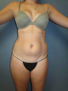 Liposuction in San Diego, CA