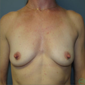 Breast Augmentation Before and After Pictures