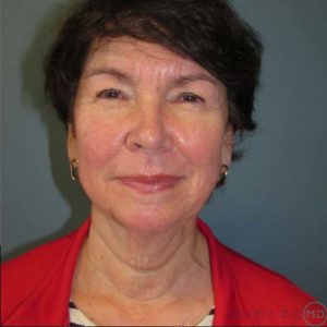 Facelift Before and After Pictures